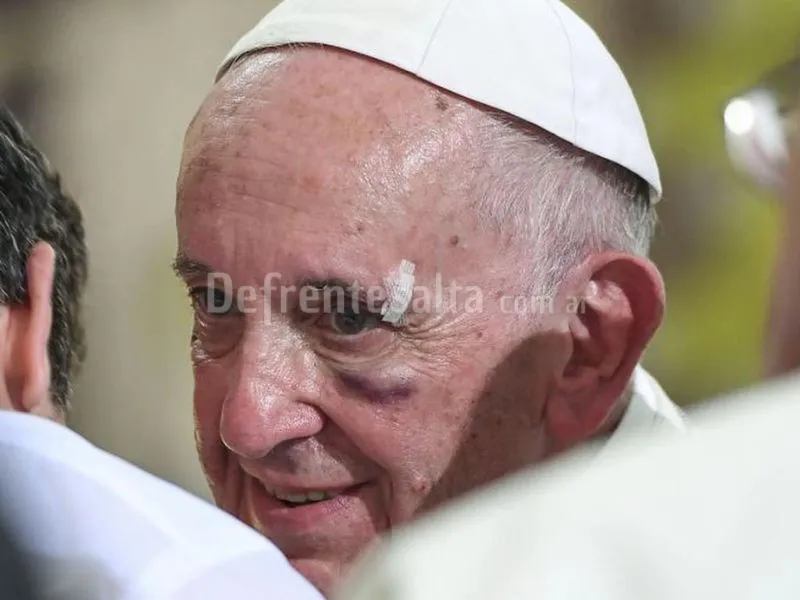 Papa Francisco con lesiones en su rostro.